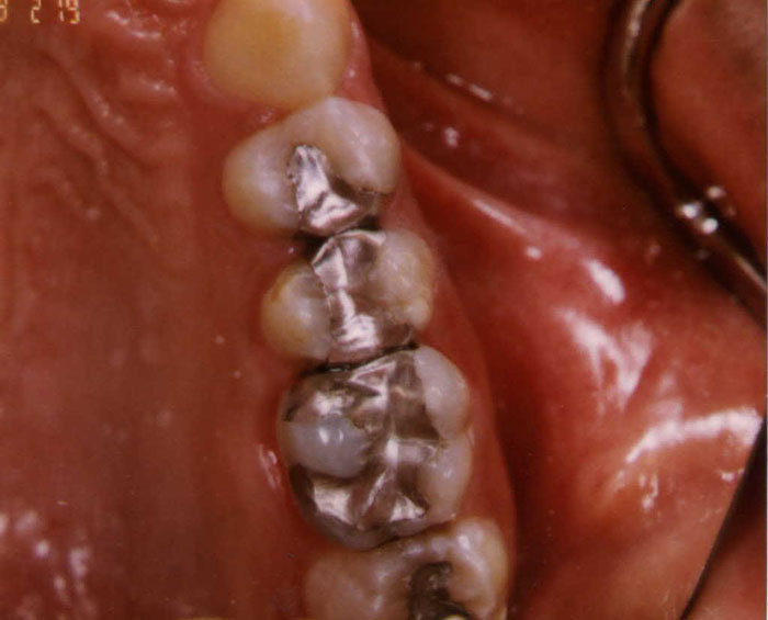 60 minutes - Is there Poison in Your Mouth